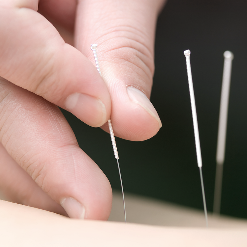 Acupuncture