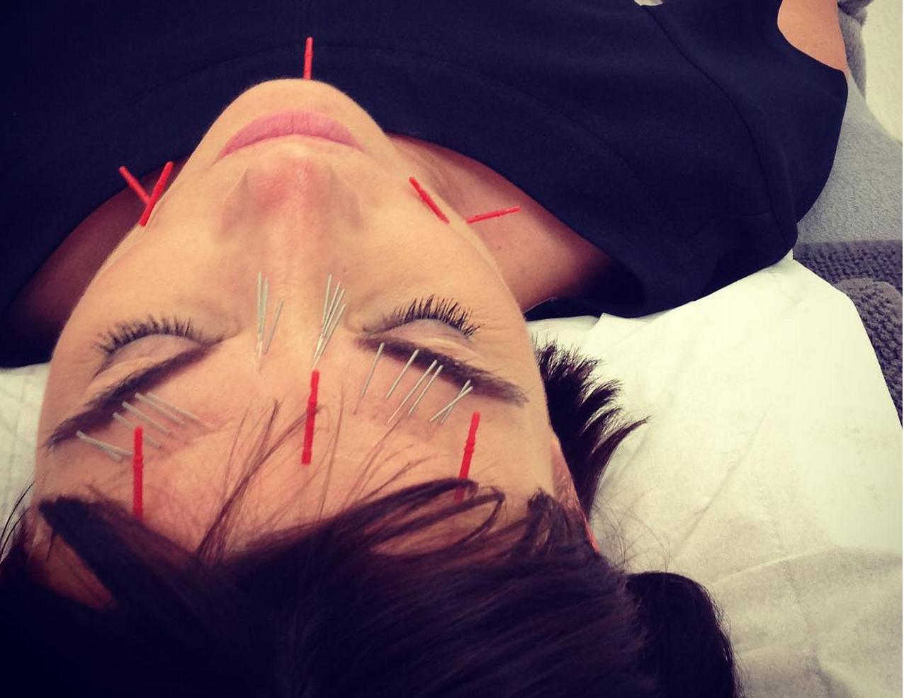 About Cosmetic Facial acupuncture