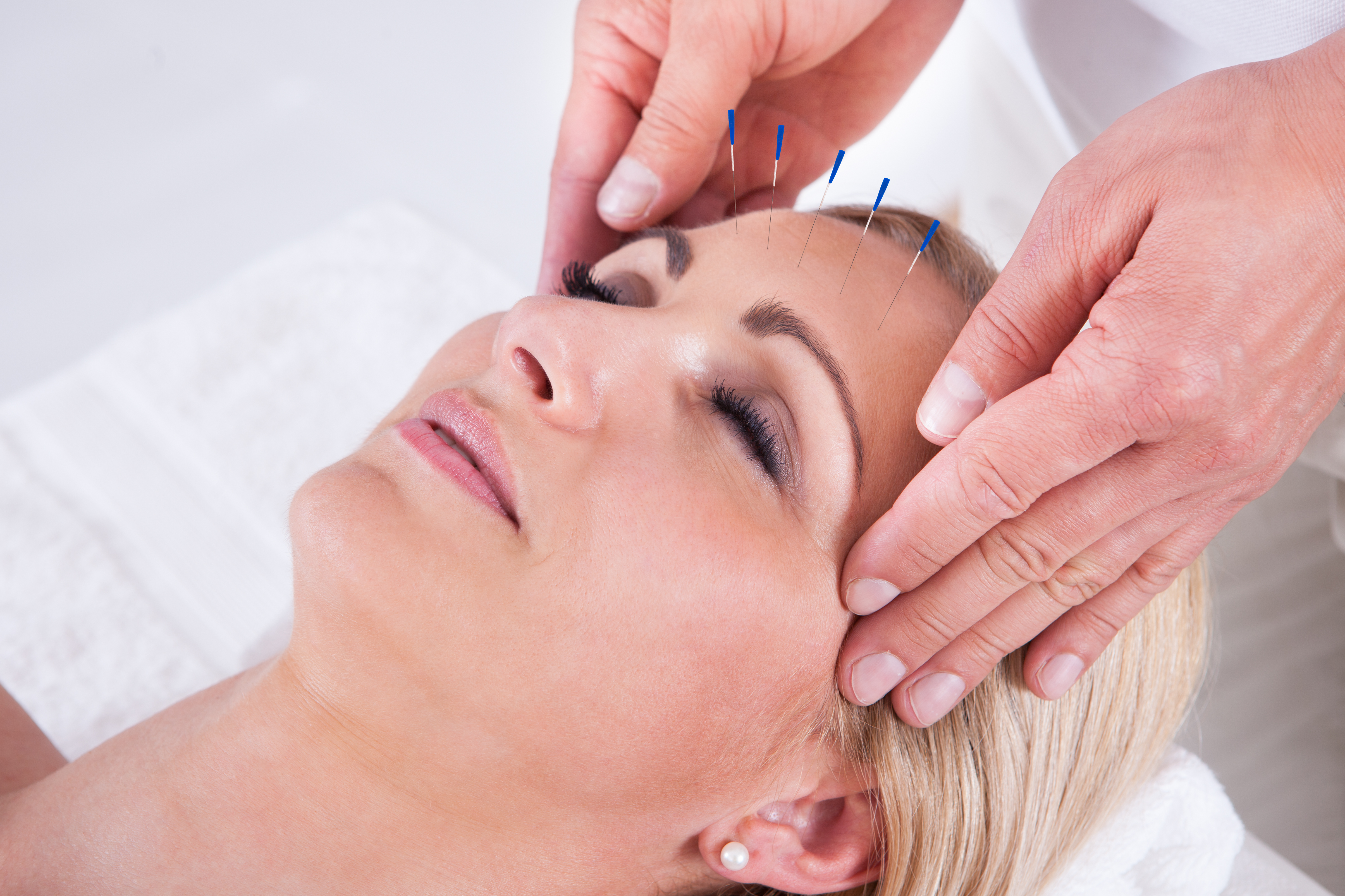 Acupuncture